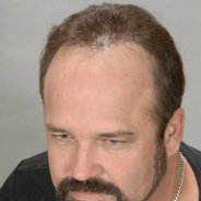 Hair Loss Restoration - Before