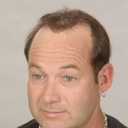Hair Loss Replacement - Before