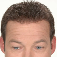 Hair Loss Replacement - After