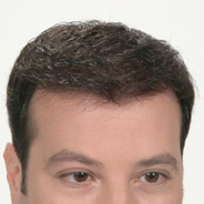 Hair Replacement - After