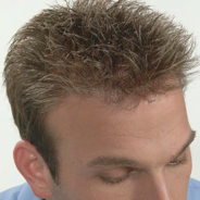 Hair Replacement - After