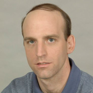 Hair Loss Replacement - Before
