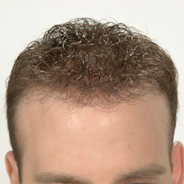 Hair Loss Replacement - After